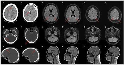 CSF <mark class="highlighted">HIV RNA</mark> Escape in Opsoclonus-Myoclonus-Ataxia Syndrome: Case Report and Review of the Literature